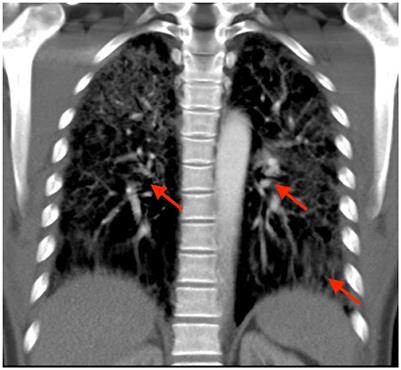 Case report: Interstitial pneumonitis after initiation of lamotrigine